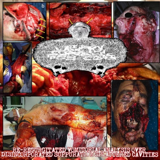 Re-Regurgitated Vomitorial Analysis Over Disincorporated Suppurative Splattered Cavities