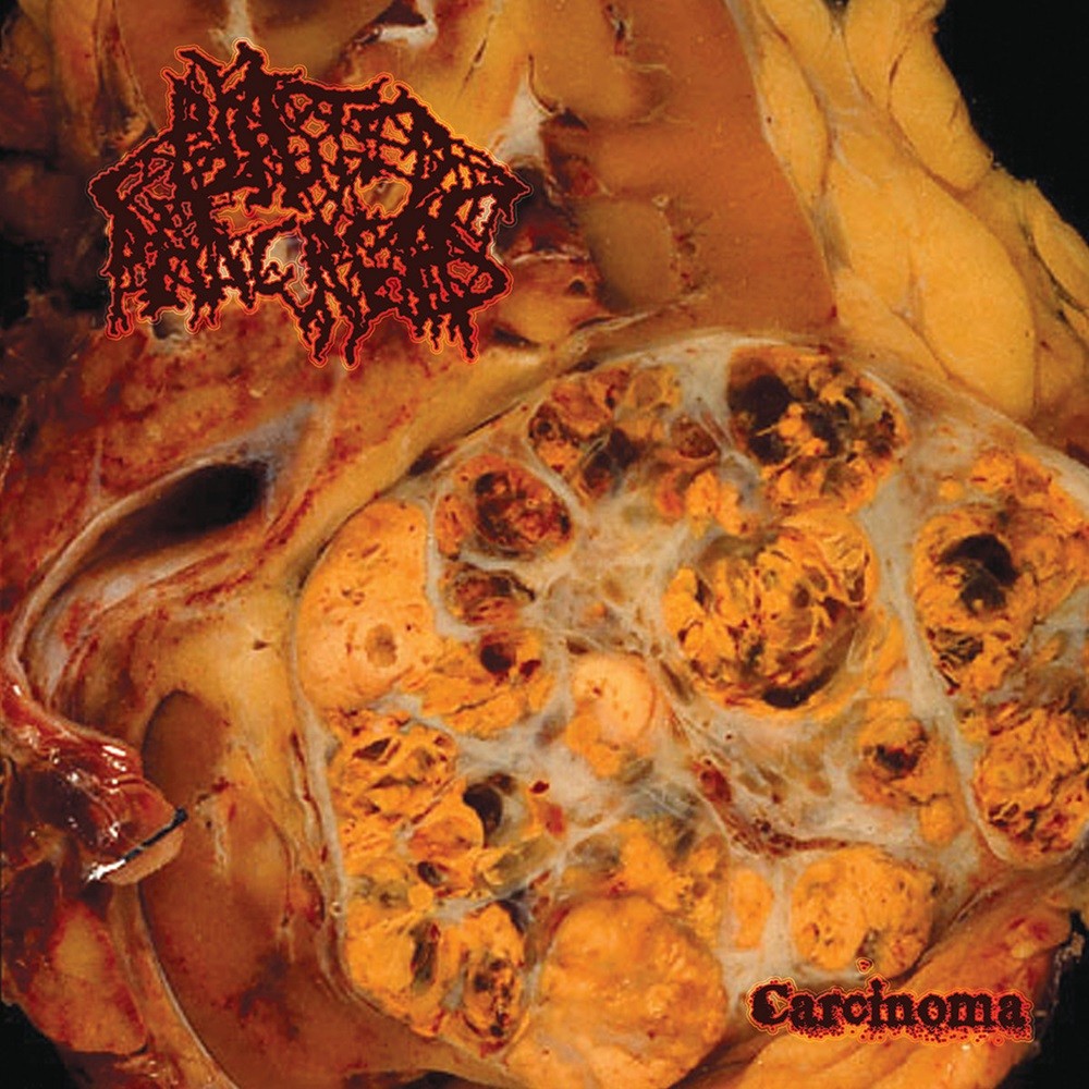 Blasted Pancreas - Carcinoma (2011) Cover