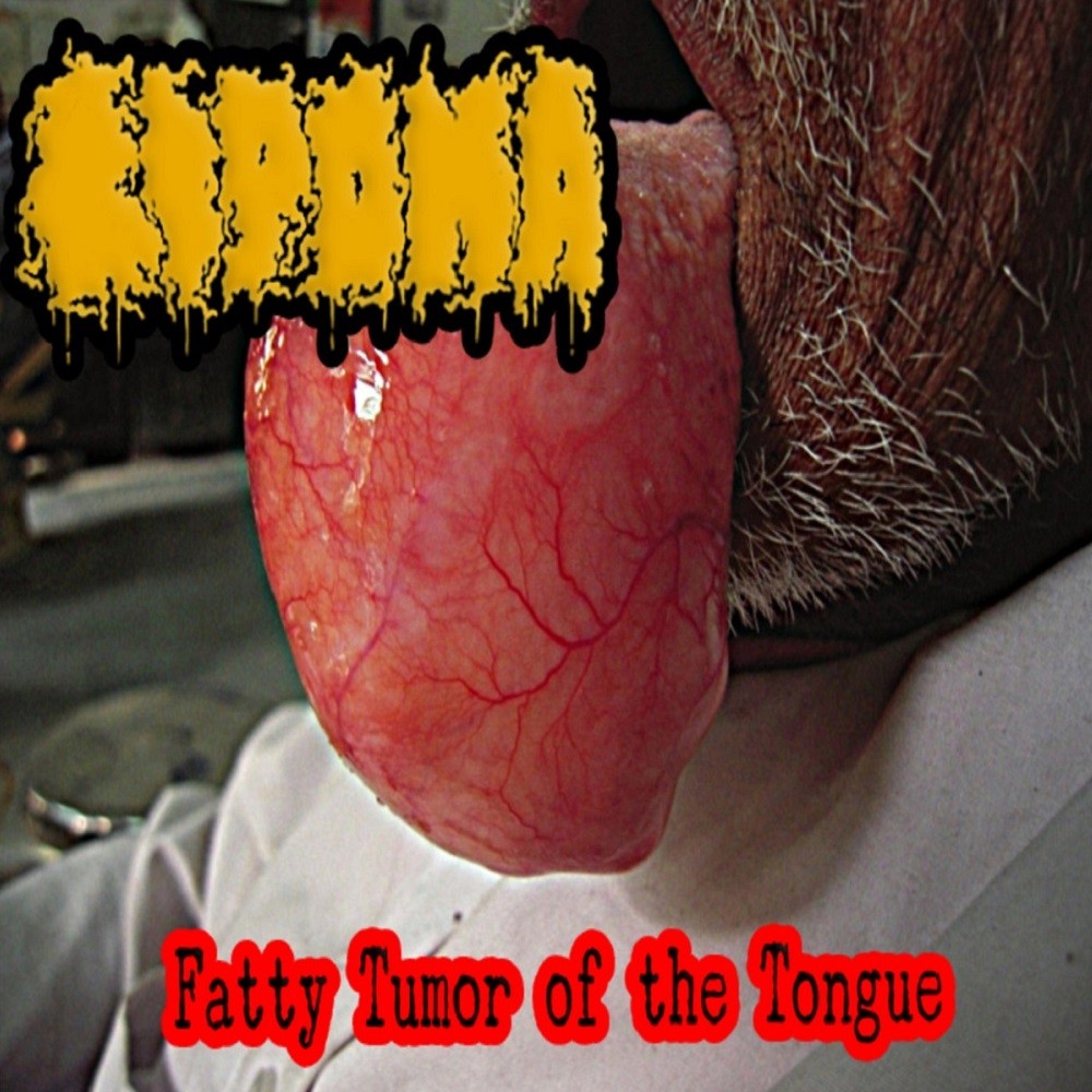 Lipoma - Fatty Tumor of the Tongue (2021) Cover