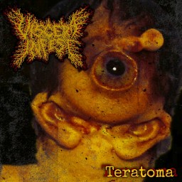 Teratoma