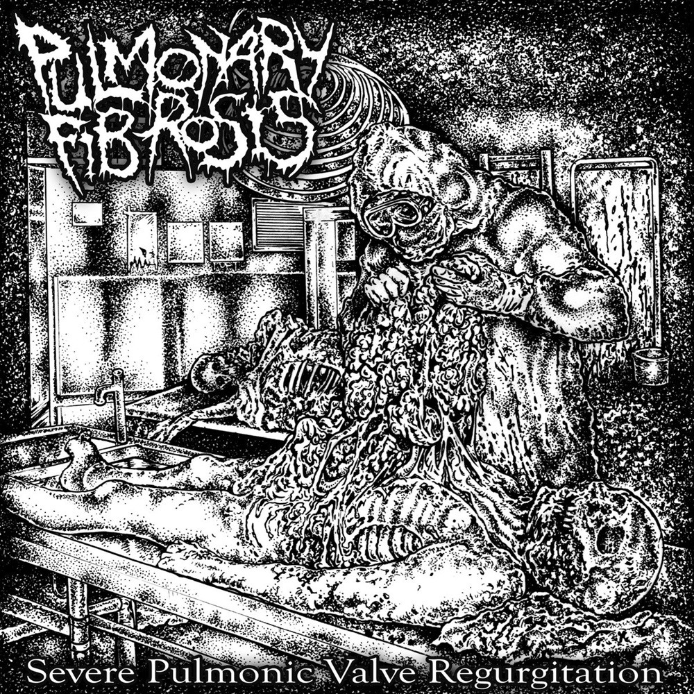 Pulmonary Fibrosis - Severe Pulmonic Valve Regurgitation (2021) Cover