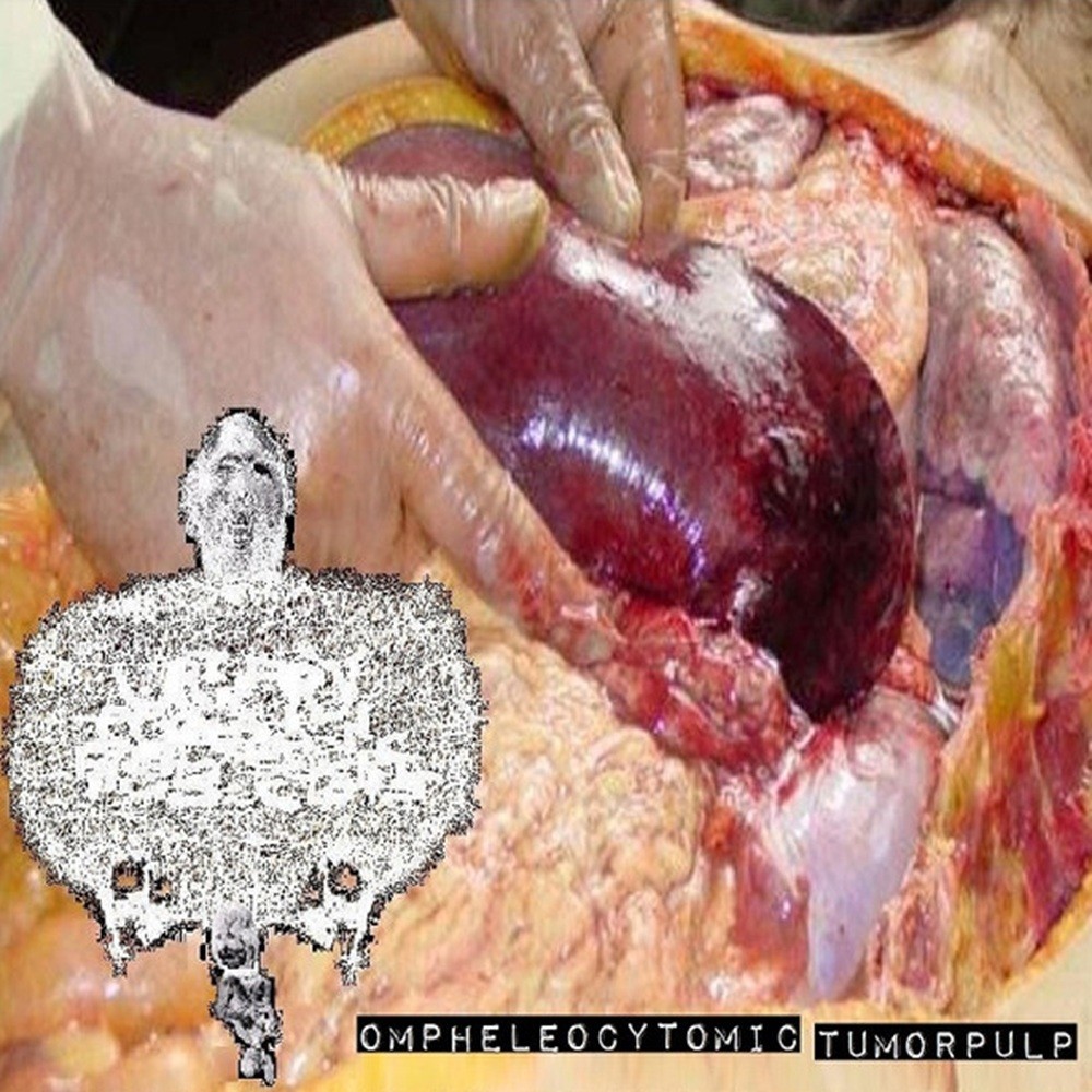 Urinary Tract Infection From Severe Pus Clots - Ompheleocytomic Tumorpulp (2016) Cover
