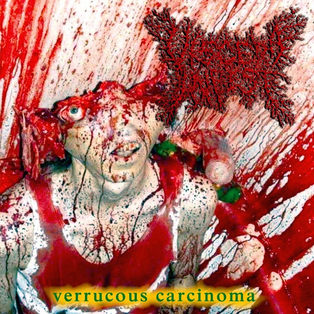 Viscera Infest - Verrucous Carcinoma (2015) Cover