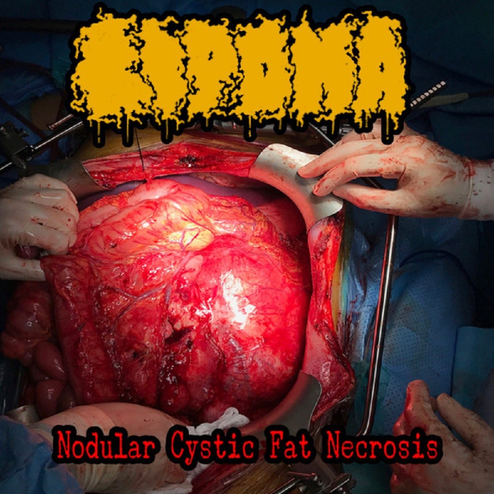 Lipoma - Nodular Cystic Fat Necrosis (2022) Cover