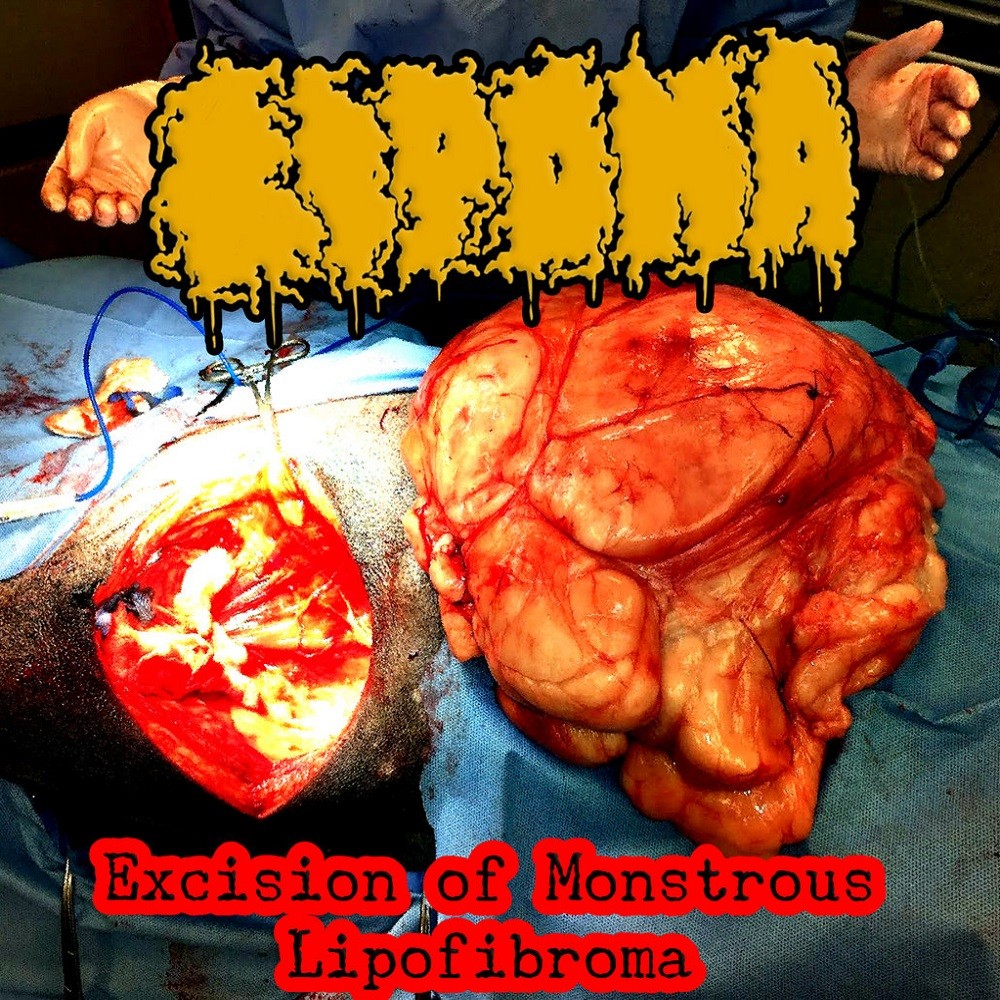 Lipoma - Excision of Monstrous Teratoma (2021) Cover