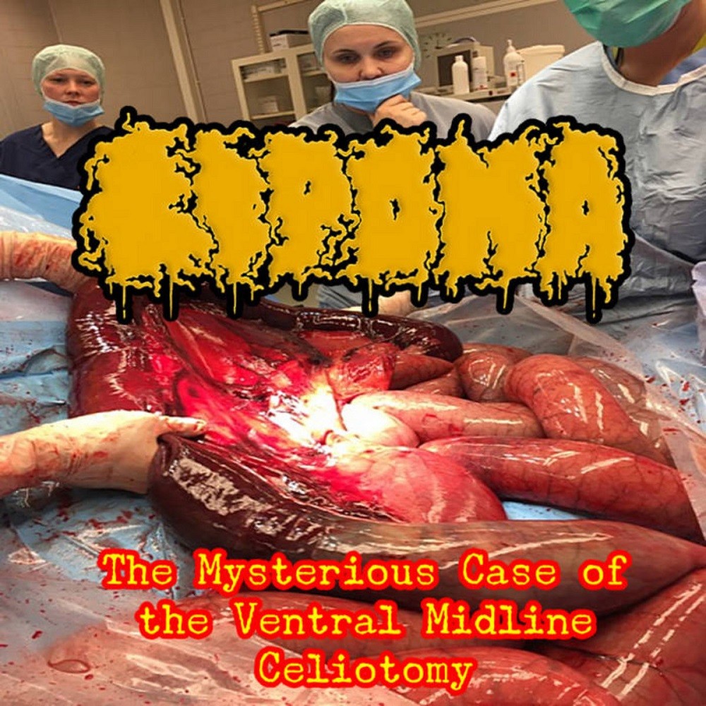 Lipoma - The Mysterious Case of the Ventral Midline Celiotomy (2021) Cover