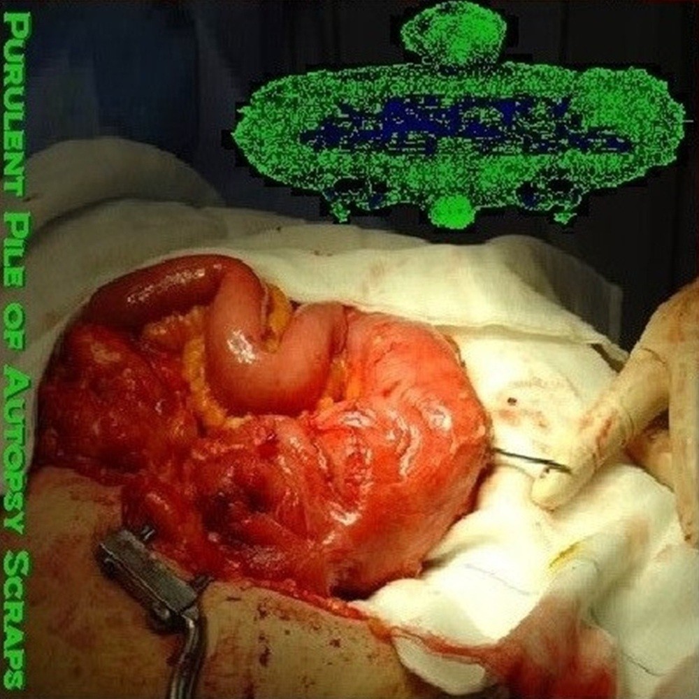 Urinary Tract Infection From Severe Pus Clots - Purulent Pile of Autopsy Scraps (2011) Cover