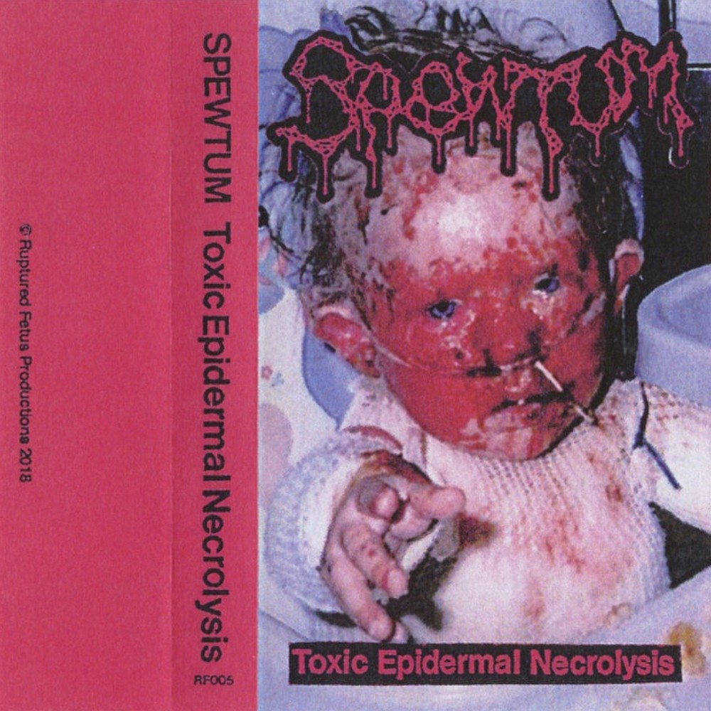 Spewtum - Toxic Epidermal Necrolysis (2019) Cover