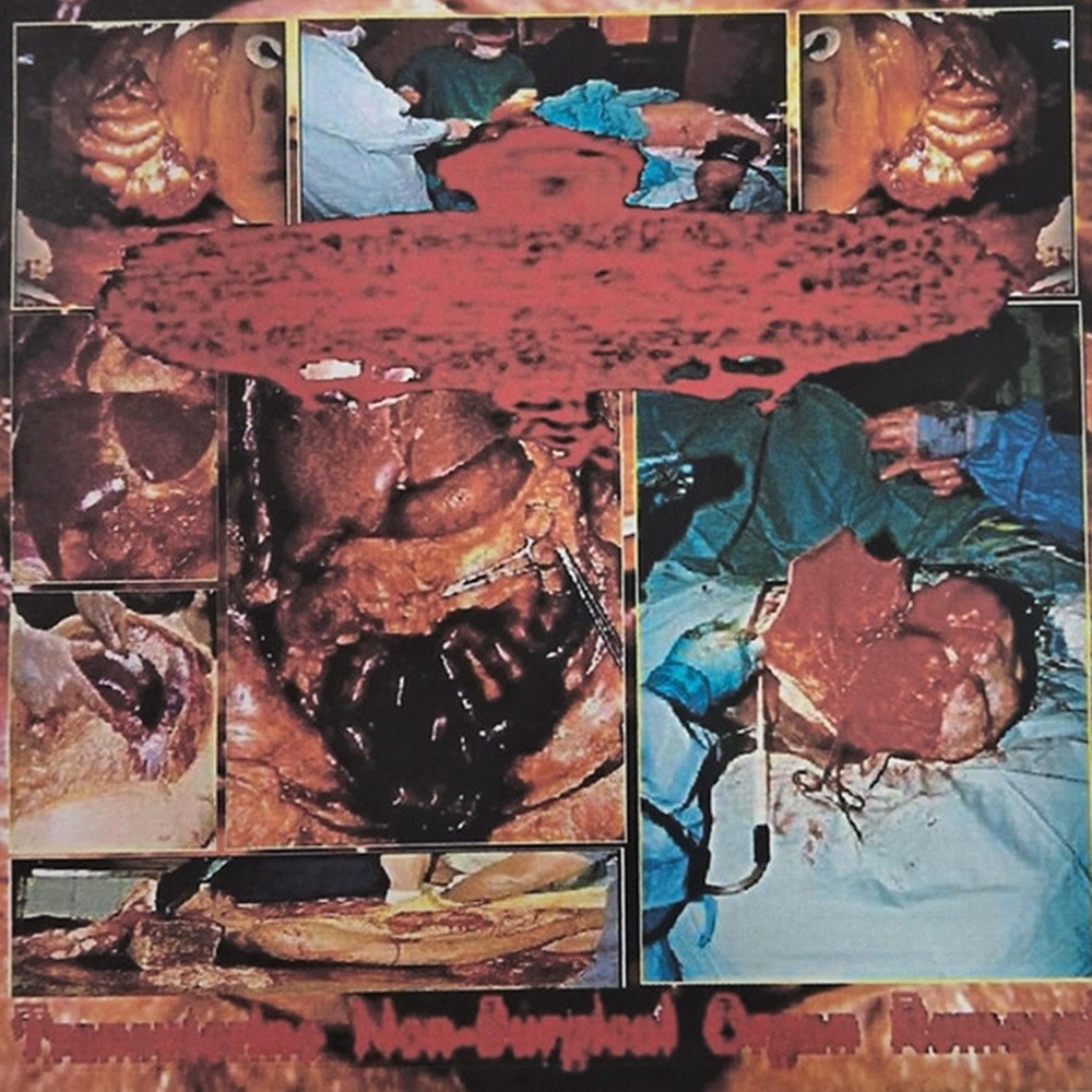 Urinary Tract Infection From Severe Pus Clots - Transuterine Non-Surgical Organ Removal (2009) Cover