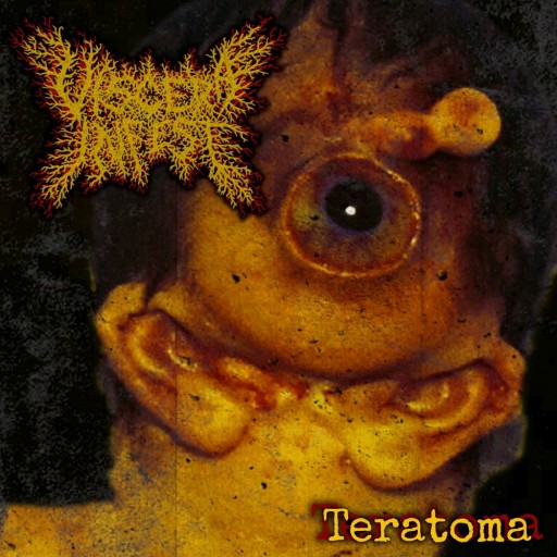 Teratoma