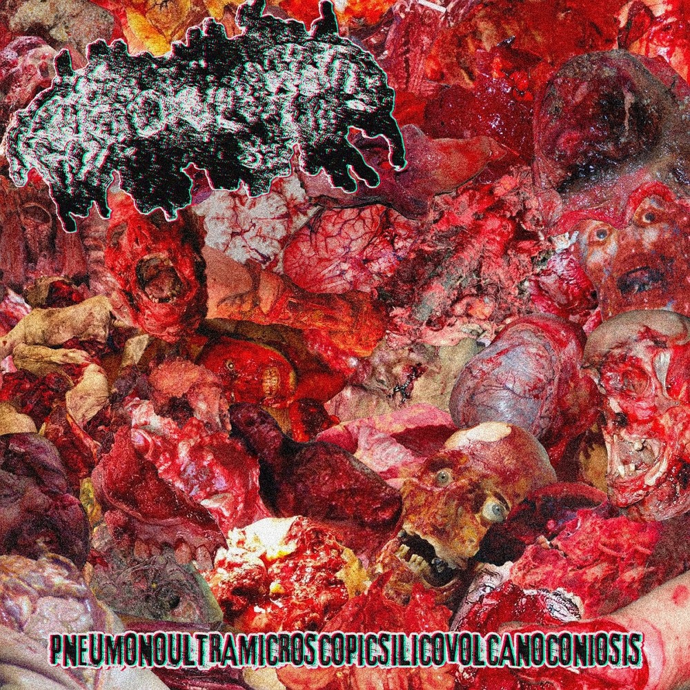 Teratoma (USA) - Pneumonoultramicroscopicsilicovolcanoconiosis (2023) Cover